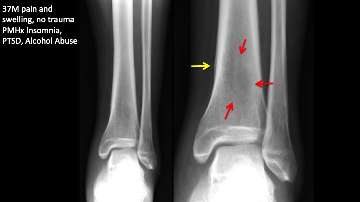 Figure 1 for case osteonecrosis ( RID5180 )